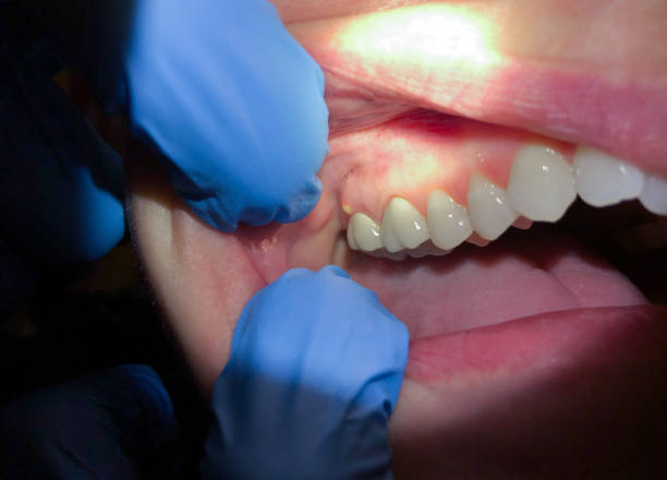 Best Emergency Care for Gum Disease in Boonville, CA