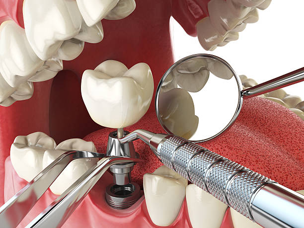 Best Knocked-Out Tooth (Avulsed Tooth) Treatment in Boonville, CA
